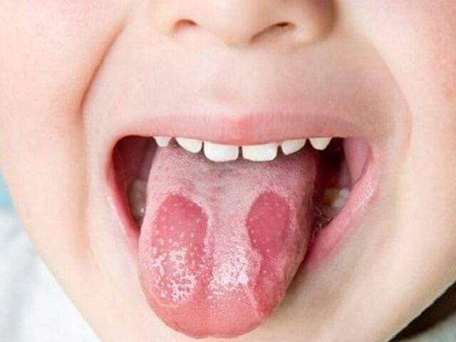 Bệnh lưỡi bản đồ ở trẻ em