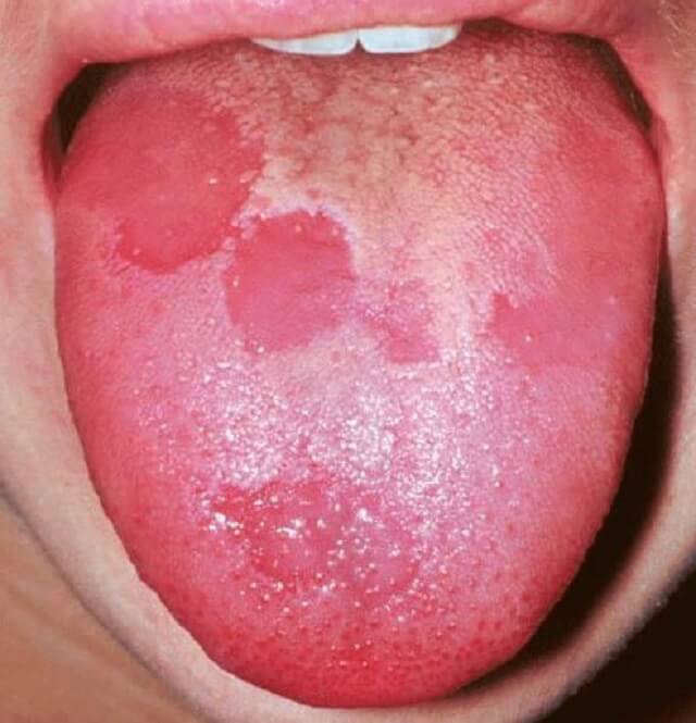 Lưỡi trẻ xuất hiện các đốm đỏ, hồng