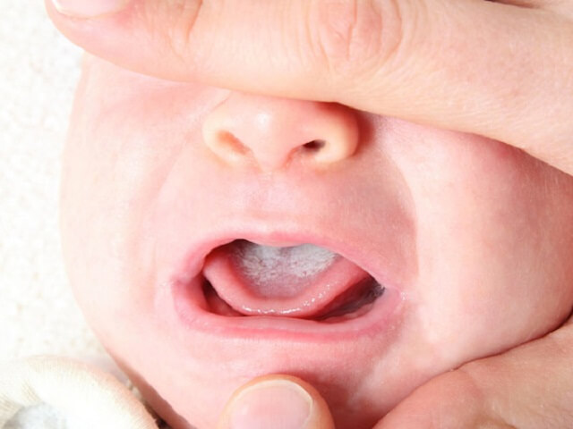 Các bệnh viêm da và niêm mạc cũng khiến trẻ bị bệnh viêm lưỡi bản đồ