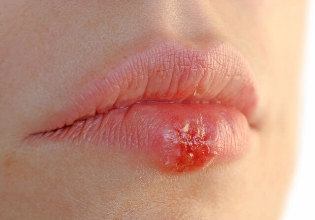 Bệnh herpes miệng ở trẻ em