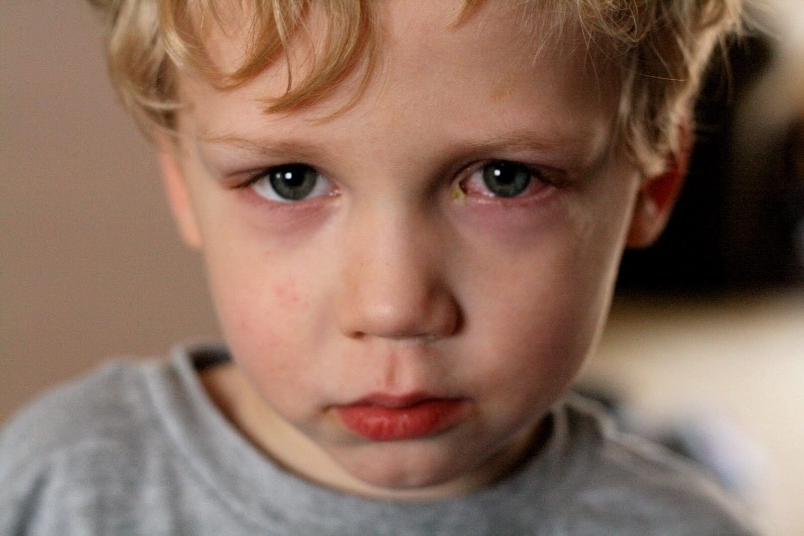 Quáng gà là dấu hiệu sớm nhất của bệnh khô mắt ở trẻ em