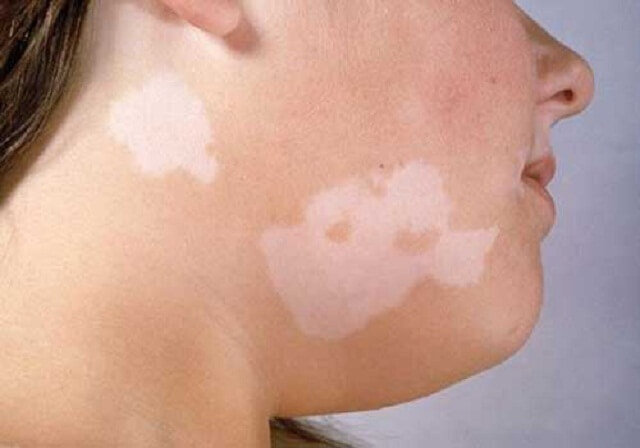 Dấu hiệu nhận biết trẻ bị bệnh lang trắng là vùng da của bé xuất hiện những mảng đốm loang lổ