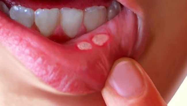 Bệnh loét miệng ở trẻ em sẽ khiến bé cảm thấy khó chịu và biếng ăn