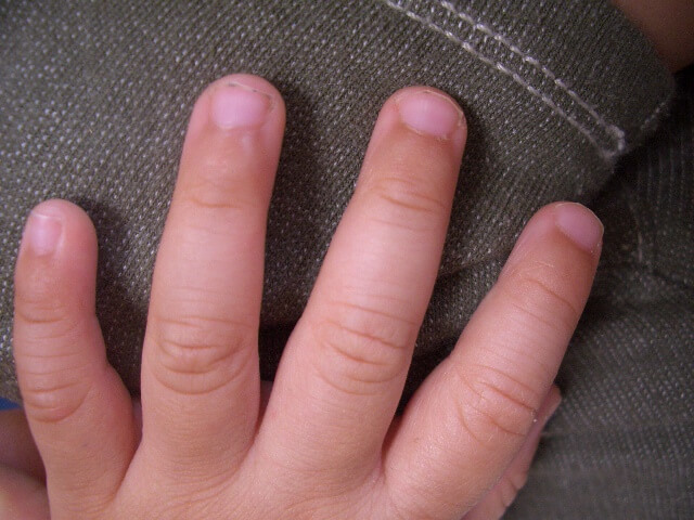 Trẻ em thường là đối tượng dễ bị mắc bệnh nấm móng tay