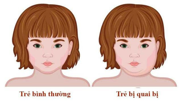 Benh Quai Bi O Tre Em Nen Kieng Gi 01
