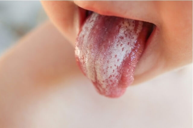 Biểu hiện của bệnh tưa lưỡi