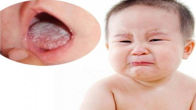 Bệnh lưỡi trắng ở trẻ