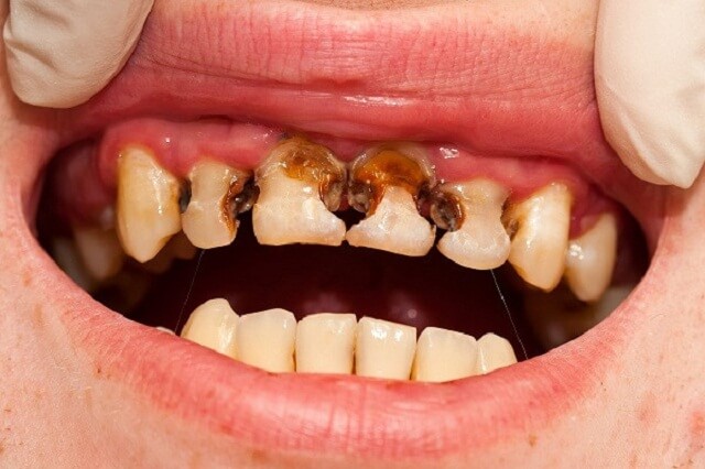 Trẻ bị sâu răng nếu không điều trị kịp thời có thể gây viêm vào bên trong