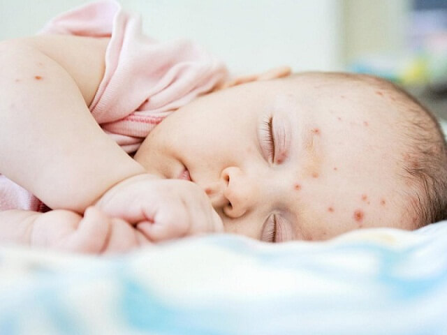Trẻ sẽ bị sốt, sau 3 – 5 ngày thì phát ban đỏ