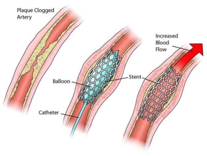 Thời gian nằm viện sau  nong động mạch cảnh và đặt stent cũng bằng thời gian của phương pháp mổ cắt nội mạch động mạch cảnh.