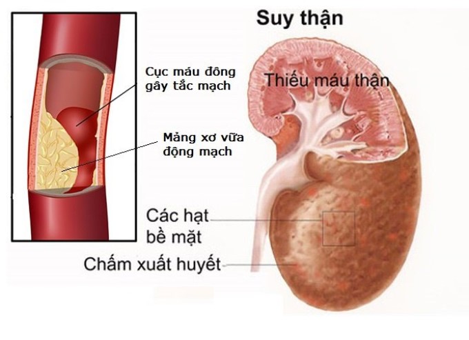 Những Điều Cần Biết Về Bệnh Động Mạch Thận 2 Xơ Vữa Động Mạch Thận Là Một Trong Những Bệnh Lý Tổn Thương Động Mạch Thận Thứ Phát