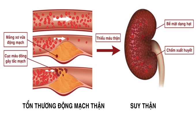 Những Điều Cần Biết Về Bệnh Động Mạch Thận 1 Động Mạch Thận Bị Xơ Vữa Dẫn Đến Suy Thận