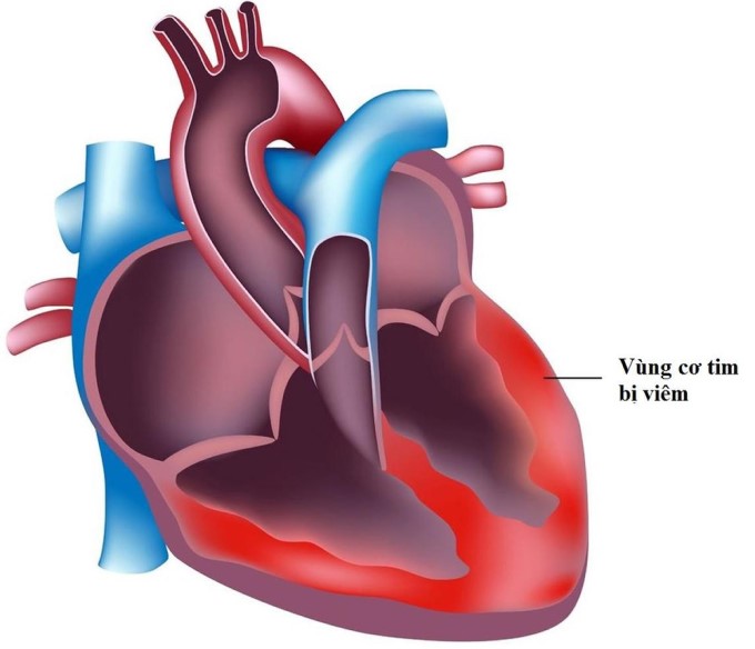 Bệnh viêm cơ tim cũng là một trong những căn bệnh về tim mạch có thể gây ra tình trạng đột tử