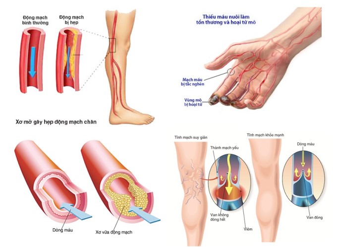 xơ vữa động mạch chi dưới gây ra biến chứng hoại tử vì tắc mạch, không cấp được máu đến nuôi dưỡng vùng sau đoạn chân bị tắc mạch