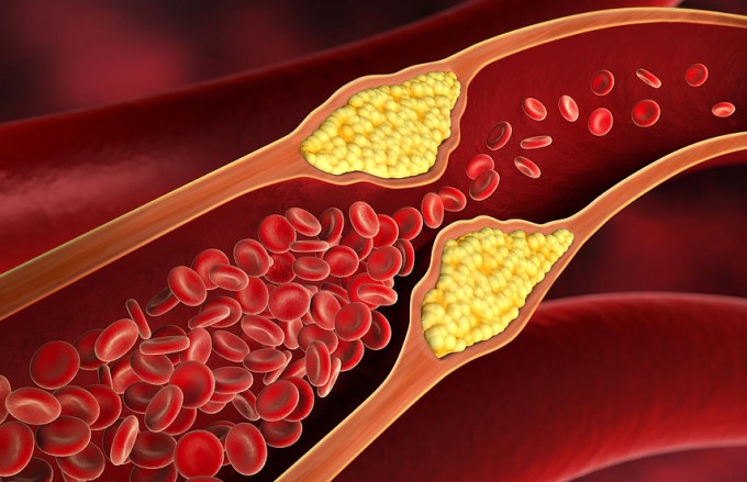 chất béo càng tích tụ làm từ cholesterol và các sản phẩm tế bào khác cũng bám tại vị trí chấn thương và làm cứng, thu hẹp các động mạch