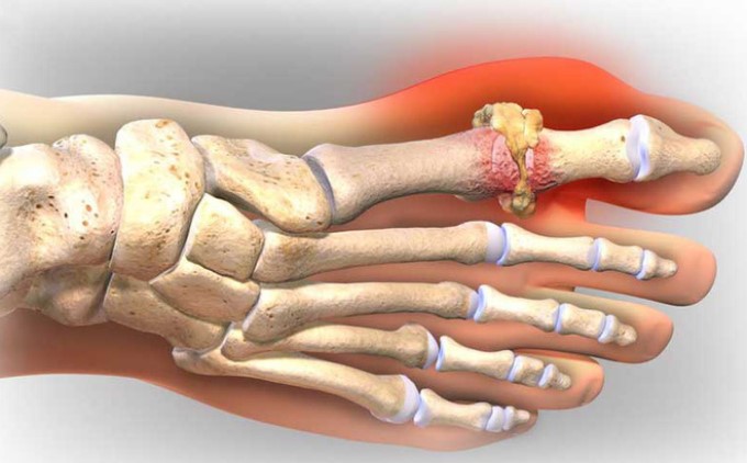 Bệnh Gout Gây Sưng Viêm, Đau Đớn Cho Người Bệnh