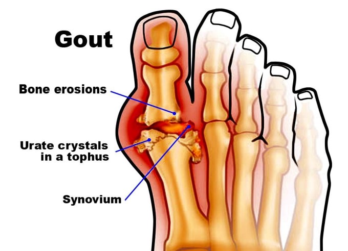 Bệnh Gout Có Nguy Hiểm Không?