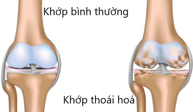 Thoái Hoá Khớp Gây Đau Nhức Khi Thời Tiết Thay Đổi