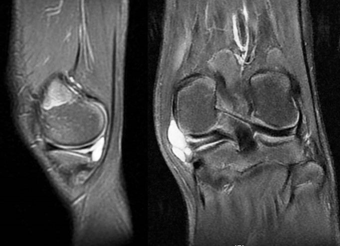 Xác Định Tình Trạng Rách Sụn Chêm Khớp Gối Thông Qua Hình Ảnh Chụp X-Quang, Mri Hoặc Siêu Âm Đầu Gối,...