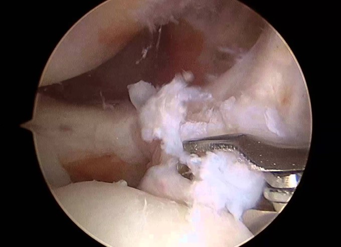 Phẫu Thuật Nội Soi Điều Trị Rách Sụn Chêm Khớp Gối
