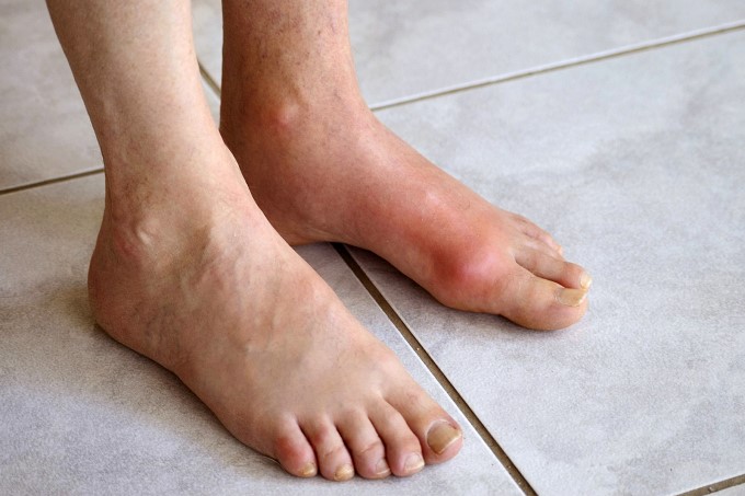Người bệnh Gout thường phải chịu những cơn đau dữ dội, nặng hơn thì sẽ kèm theo những biến chứng khác