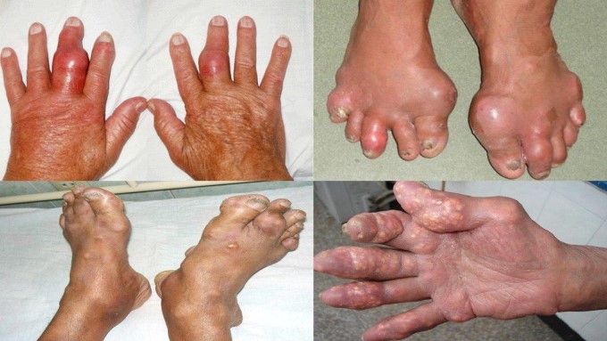 Khớp Bị Tàn Phá, Biến Dạng Nặng Nề