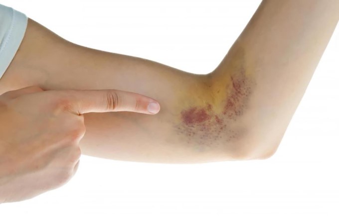 Xuất Huyết Do Giảm Tiểu Cầu Cũng Là Biểu Hiện Của Bệnh