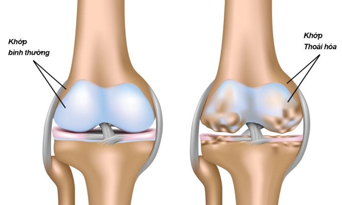 Thoái Hoá Khớp Gối Là Nguyên Nhân Hàng Đầu Dẫn Đến Đau Khớp Gối