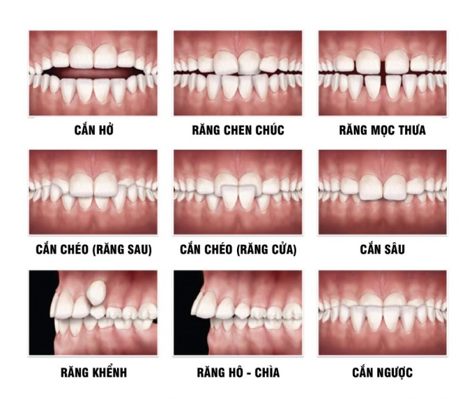 Những Dạng Lệch Khớp Cắn Phổ Biến