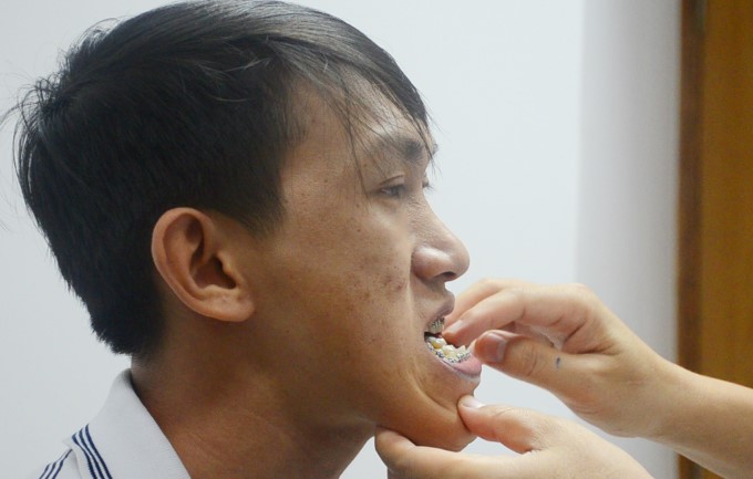 Lệch Khớp Cắn Gây Mất Thẩm Mỹ Cũng Như Khó Khăn Trong Việc Ăn Uống, Giao Tiếp