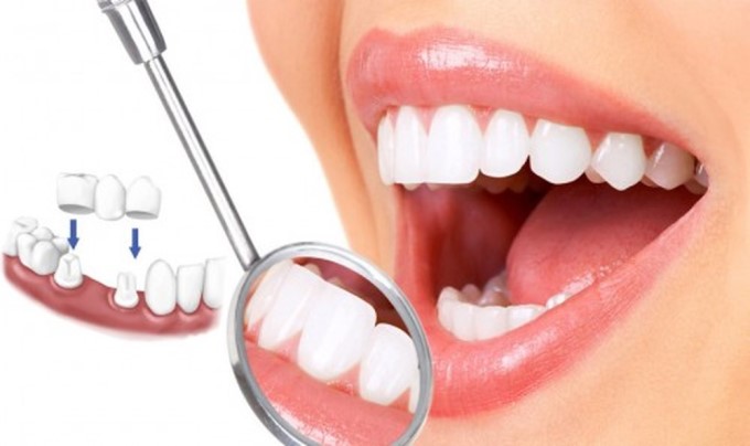 Bọc Răng Sứ Cho Những Trường Hợp Sai Lệch Không Phải Do Xương Hàm