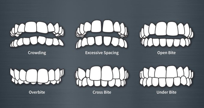 Lệch Khớp Cắn Được Biết Đến Là Hiện Tượng Răng Mọc Lệch Lạc