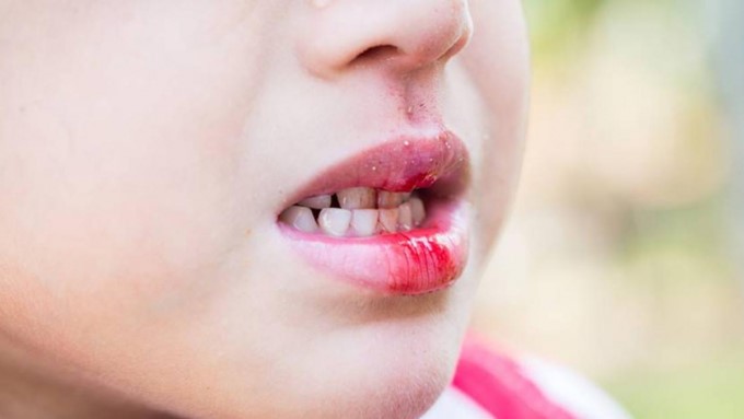 Tác Động Của Ngoại Lực Làm Răng Mọc Không Đúng Vị Trí (Đối Với Trẻ Nhỏ)