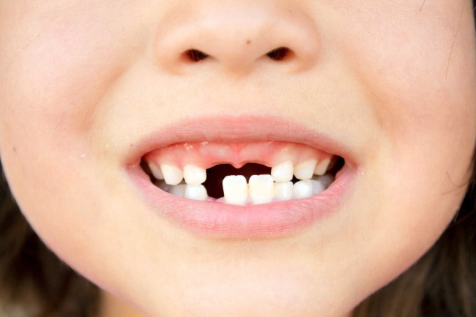 Mất Răng Sữa Quá Sớm Cũng Là Một Trong Những Nguyên Nhân Gây Lệch Hàm