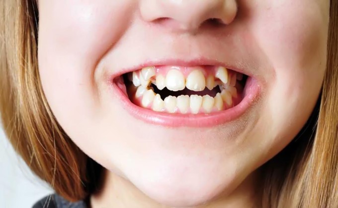 Khớp Cắn Bị Hở Và Răng Mọc Chen Chúc