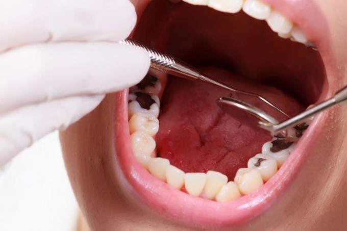 Lệch Khớp Cắn Làm Ảnh Hưởng Đến Sức Khoẻ Răng Miệng