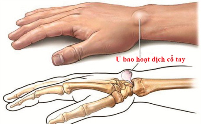 Nguyên Nhân Của U Bao Hoạt Dịch Khớp Cổ Tay Chưa Được Xác Định Cụ Thể