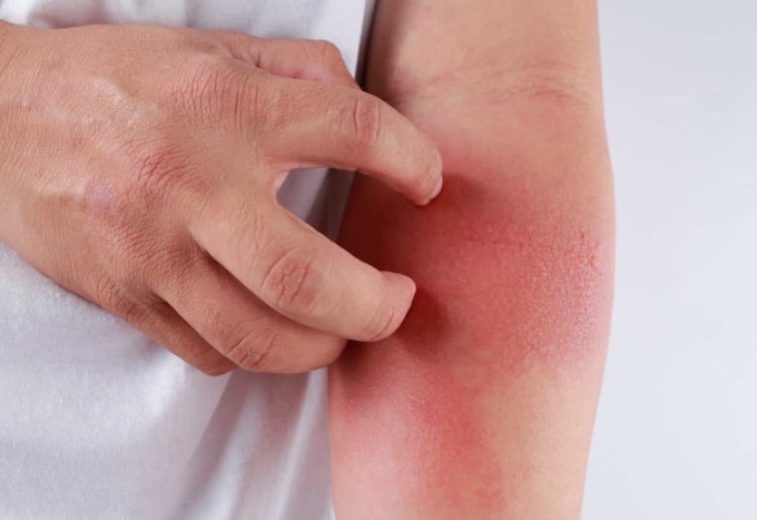 Tấy Đỏ Khu Vực Bị Viêm