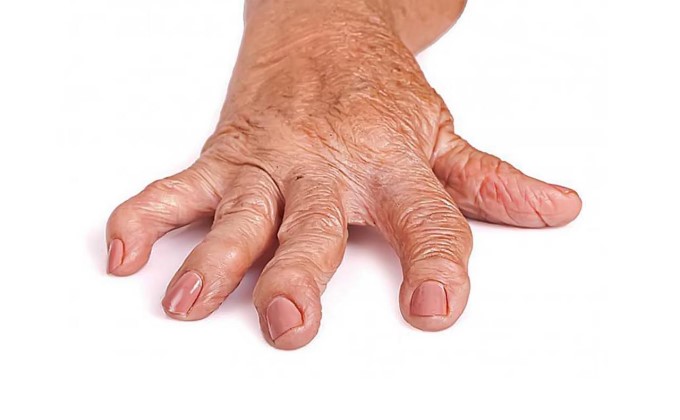 Ngón Tay Bị Biến Dạng Do Viêm Khớp