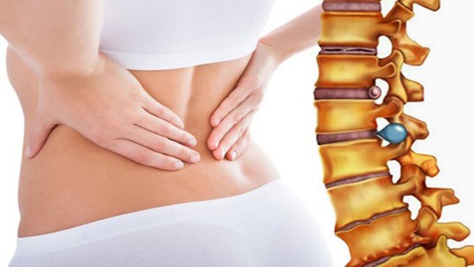 Thoát Vị Đĩa Đệm Gây Nên Những Cơn Đau Cho Người Bệnh