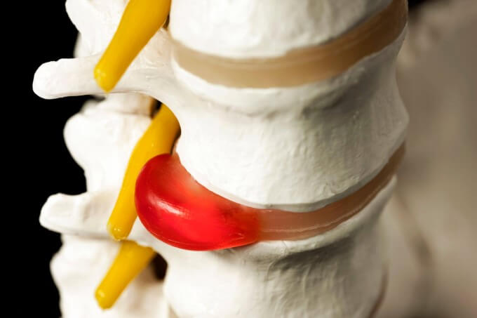 Nếu Không Được Điều Trị Kịp Thời, Thoát Vị Đĩa Đệm Có Thể Gây Những Biến Chứng Nặng Nề