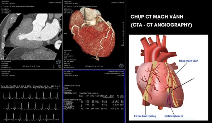 Chẩn Đoán Bằng Phương Pháp Chụp Ct Tim