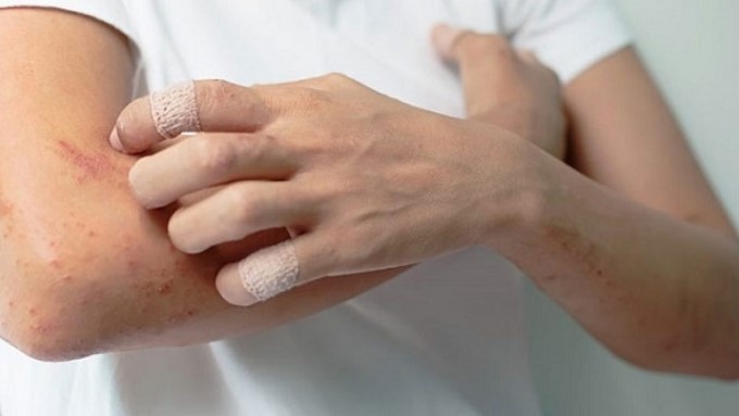 Triệu Chứng Là Viêm Mạch Máu