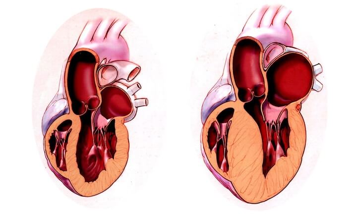 Bệnh cơ tim phì đại và những điều cần biết!