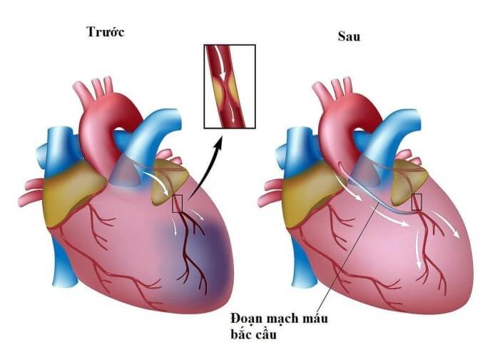 Phẫu Thuật Bắc Cầu Nối Chủ Vành