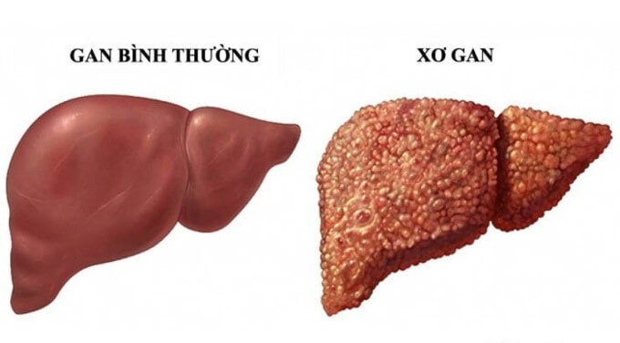 Nguyên Nhân Chủ Yếu Là Do Xơ Gan