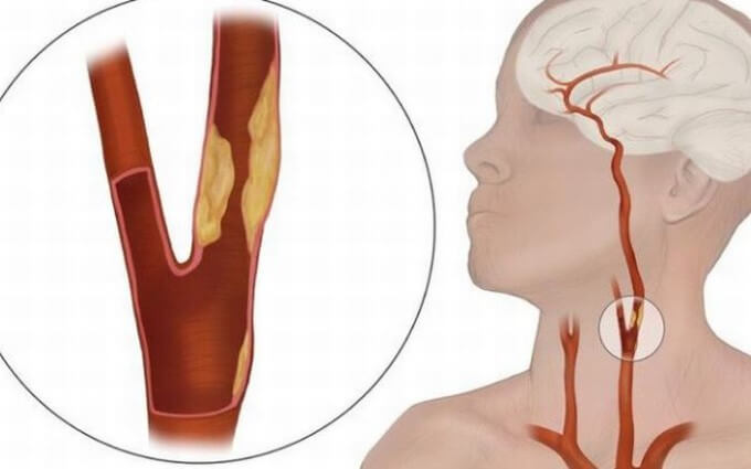 Động Mạch Cảnh Bị Hẹp Làm Thiếu Máu Nuôi Dưỡng Não