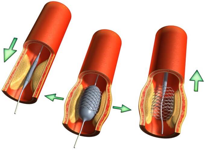 Đặt Stent Vào Lòng Động Mạch Cảnh Để Giữ Lòng Mạch Luôn Mở