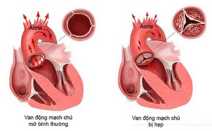 Hở Van Tim 3 Lá Là Một Trong Những Bệnh Lý Về Van Tim