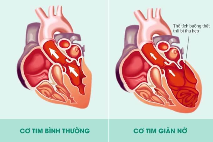 Giãn Nở Cơ Tim Có Thể Gây Ra Hở Van Tim 3 Lá